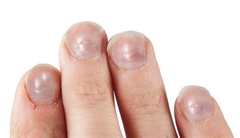 Ridges In Fingernails: Types, Causes, And Treatment | atelier-yuwa.ciao.jp