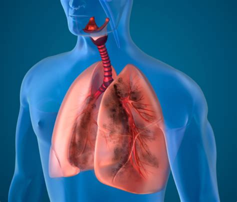 Interstitial Lung Disease Causes