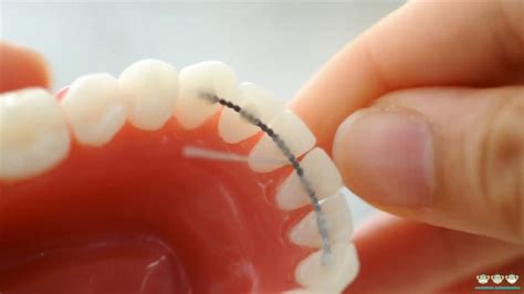 How To Floss With Permanent Retainer? : A Step By Step Guidance