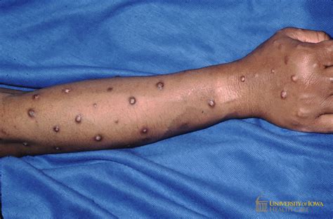 Multiple crusted hypopigmened nodules and plaques with rim of hyperpigmentation on the arm ...