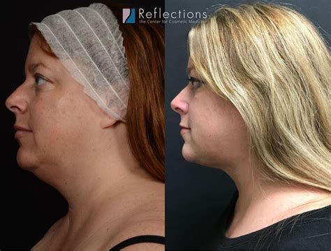 Laser Lipo Results for Double Chin on New Jersey Woman Before & After Photos New Jersey ...