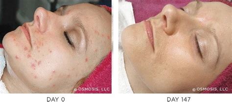 med-spa-acne-treatment-options | PLEIJ Salon + Spa