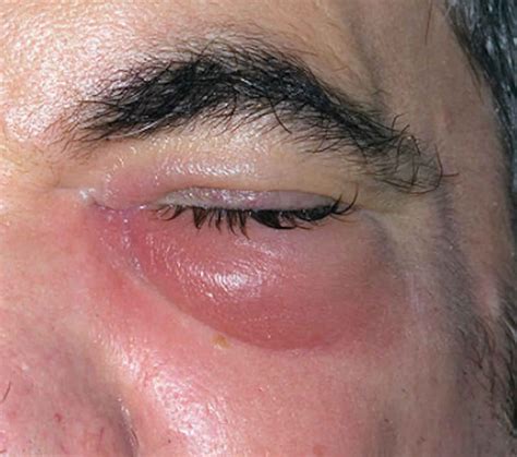 Cellulitis eye, causes, signs, symptoms, diagnosis, treatment & prognosis