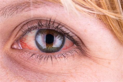 5 Causes of Red Eye - Carmi Eye Care Carmi, IL