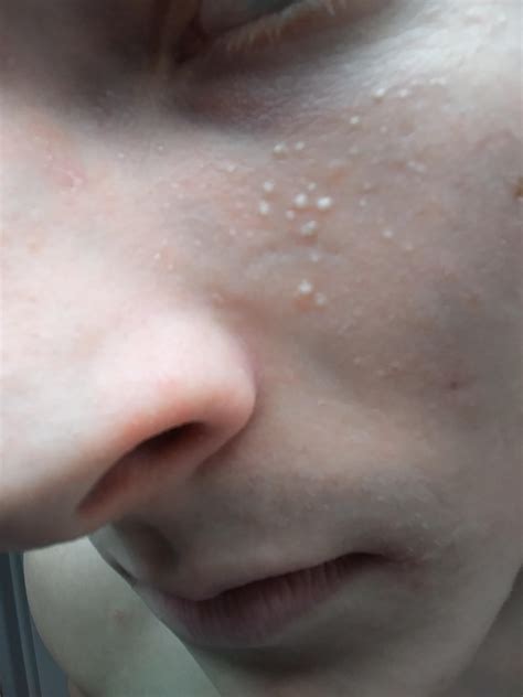 Milia on face. What can be done? : r/acne