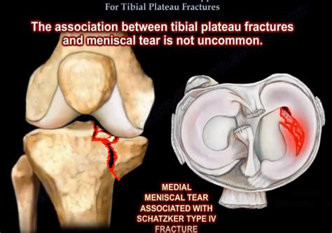 Extensile Approach for Tibial Plateau Fractures — OrthopaedicPrinciples.com