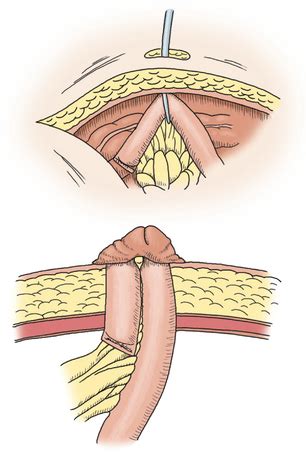 Ileostomy | Basicmedical Key