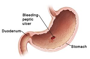 Best Otc Medicine For Stomach Ulcer - MedicineWalls