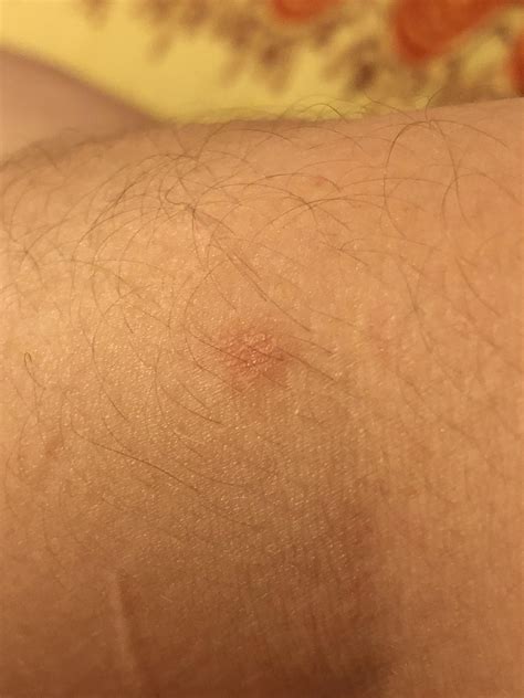 Is this a wart? This is on my arm near my elbow : r/Warts