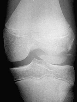 Patellar Instability - Knee & Sports - Orthobullets