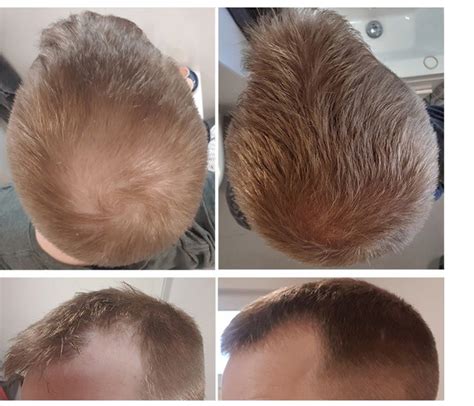 Finasteride Results: Timeline, Photos, Before & After