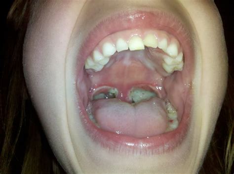 What Are Adenoids And Tonsils