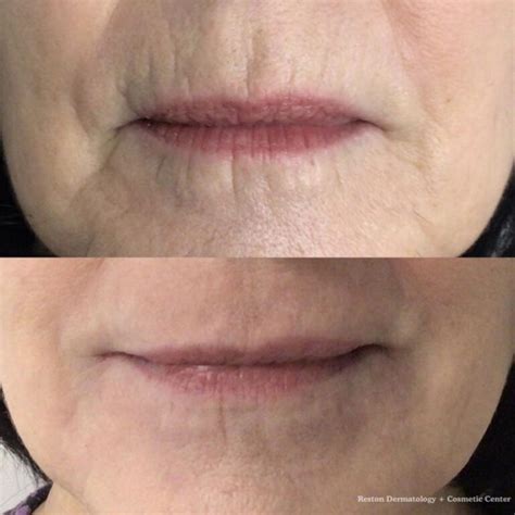 The Best Treatment for Wrinkles Above Lips - Reston Dermatology + Cosmetic Center