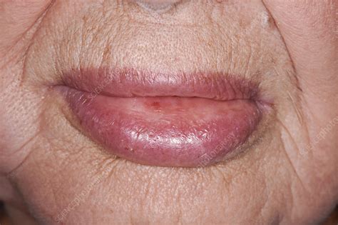 Angioedema Lips Pictures | Lipstutorial.org