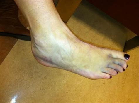 Immediate Care of Acute Ankle Sprain | Sprained ankle, Sprain, Torn ligament in ankle