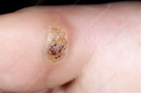 Wart on the big toe - Stock Image - C014/2814 - Science Photo Library