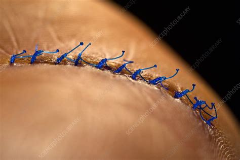 Surgical sutures - Stock Image - C011/9823 - Science Photo Library