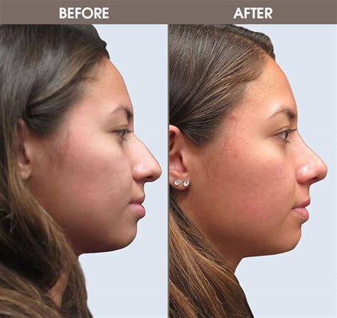 Best Ethnic Rhinoplasty Surgeon Nyc - Get More Anythink's