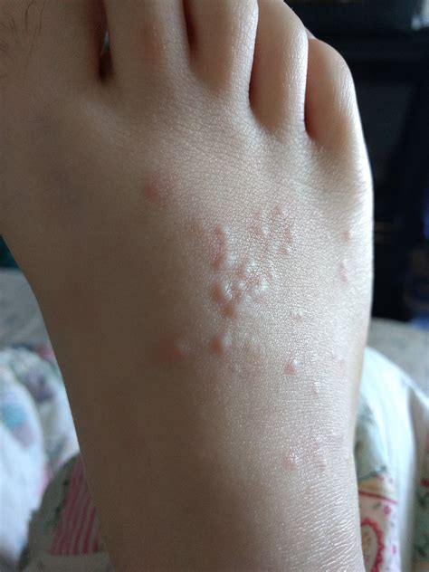 small bumps on top of foot : AskDocs