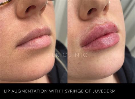 Lip Filler Before After Natural - Infoupdate.org