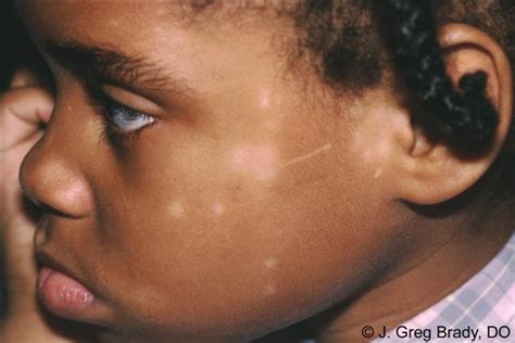 Pityriasis Alba - Pityriasis Alba Photo Skin Disease Pictures, How the patches look may bother ...