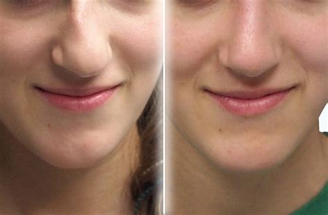 Before & After: Face Procedures - Penn Medicine Cosmetic Services