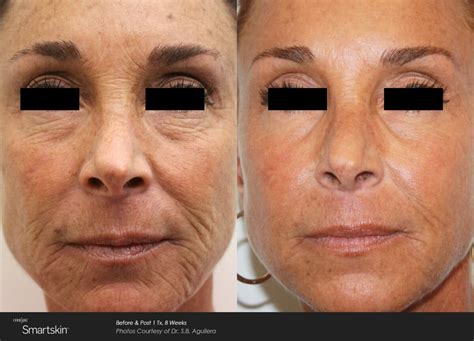 Laser Skin Resurfacing Archives - NKP Medical Marketing