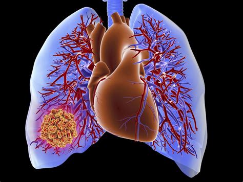 FOCUS May Be Useful for Ruling Out Pulmonary Embolism in Patients Presenting to the ED With ...