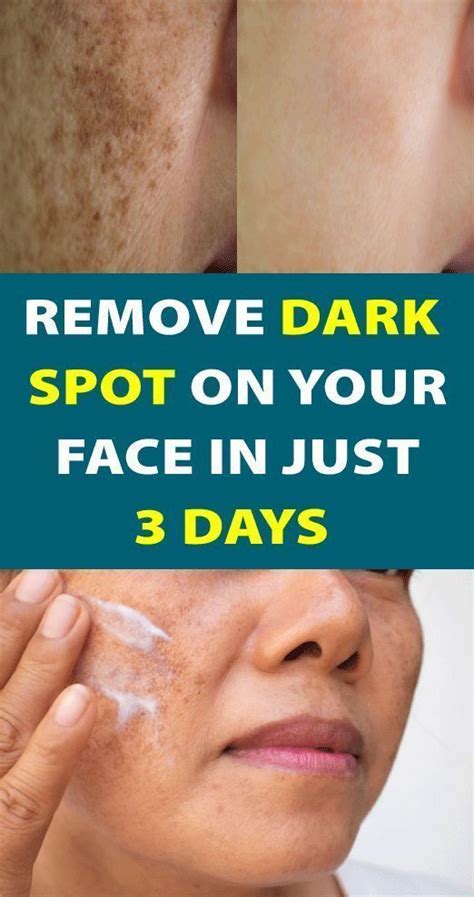 Simple Trick to Remove Brown Spots from Your Skin | Remove dark spots, Good skin tips, Skin spots