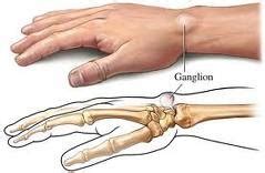 Ganglion cyst - CHILLAPPLE Group International Health Blog - Diseases,Conditions,treatment,Diet