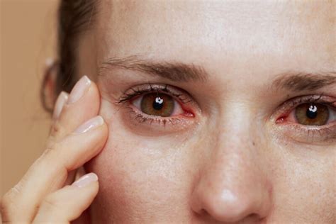 Eye Allergies: Most Common Reasons For Itchy Red Eyes | Allergy ...