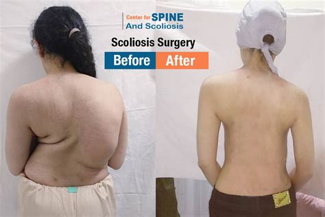 Best treatment for Scoliosis at the Center Spine India - Dr Hitesh Garg