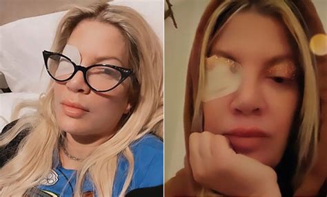 Tori Spelling gets eye ulcer after wearing contact lenses for 20 days ...