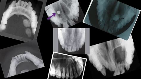 The Purpose Of The Occlusal Technique - Occlusal Radiographs - YouTube