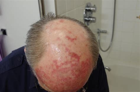 Scalp edema | Query