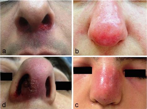 Nasal Infections | SpringerLink