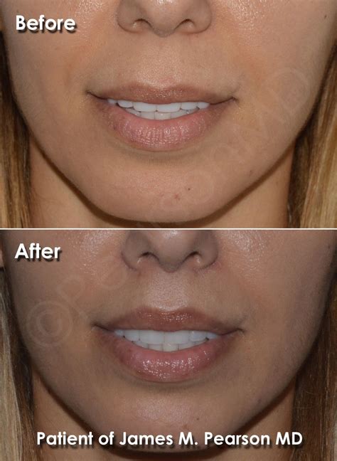 Face Plastic Surgery, Lip Surgery, Teeth Shape, Reconstructive Surgery, Facial Plastic, Upper ...