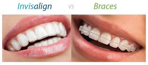 Invisalign Cost Melbourne, VIC - Care Family Dental