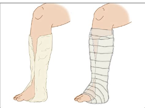 Ankle Sprain (Twisted Ankle) | Anesthesia Key