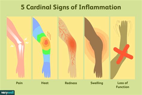 Quels sont les 5 signes cardinaux de l'inflammation