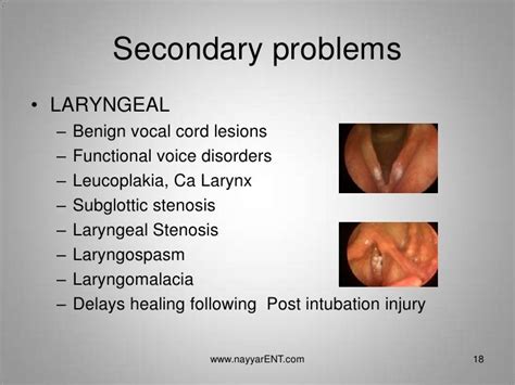 LPR Laryngopharyngeal Reflux | Laryngopharyngeal reflux, Reflux, Reflux symptoms