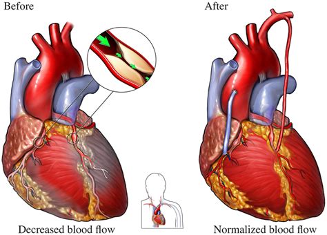 Pdf Body Image Before And After Coronary Artery Bypass Graft Surgery | My XXX Hot Girl