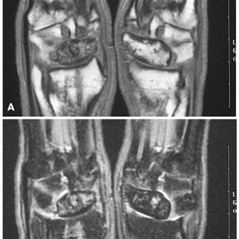 The reverse-flow vascularized bone graft based on the 2,3... | Download ...