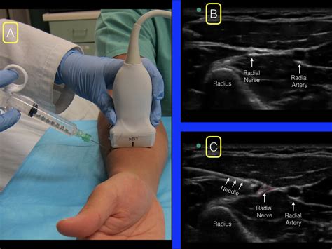 Forearm blocks — Highland EM Ultrasound Fueled pain management