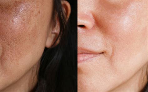 What Causes Uneven Skin Texture? | Perfection Plastic Surgery & Skin Care