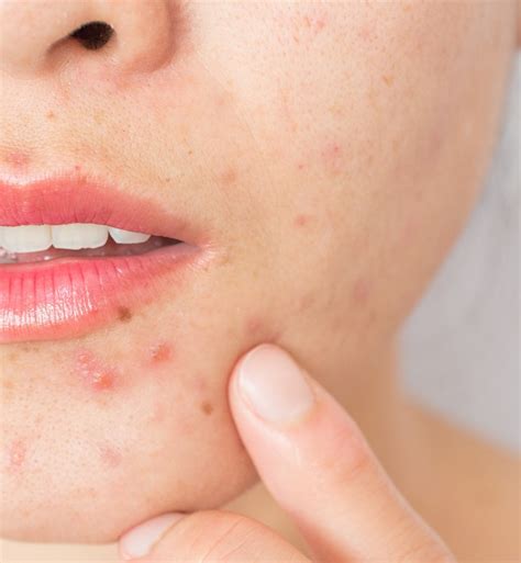 Have You Tried Zinc for Acne? Here's What to Know