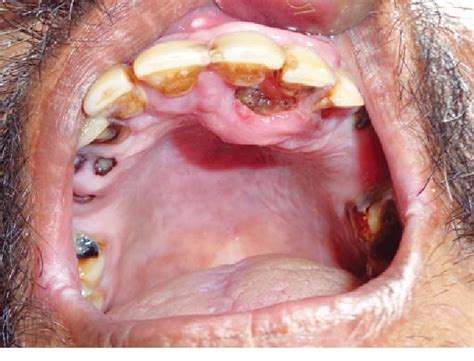 [PDF] Maggots in the Mouth— Oral Myiasis: A Rare Case Report | Semantic Scholar