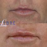 Lip Filler Before and After Pictures | Book Appointment