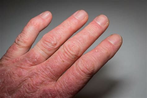 Symptoms of Psoriatic Arthritis - Eremedium