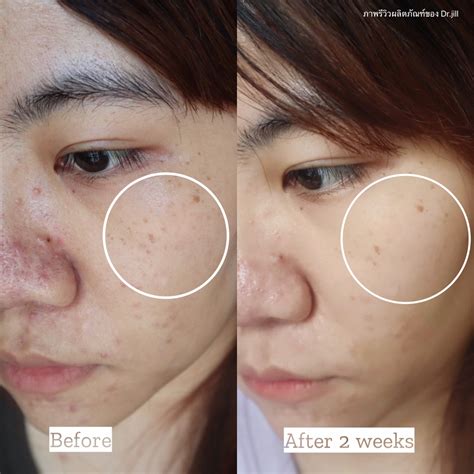 รีวิวก่อนใคร! ครีมทาฝ้าตัวใหม่ของ Dr.JiLL ADVANCED ANTI-MELASMA รักษา ...